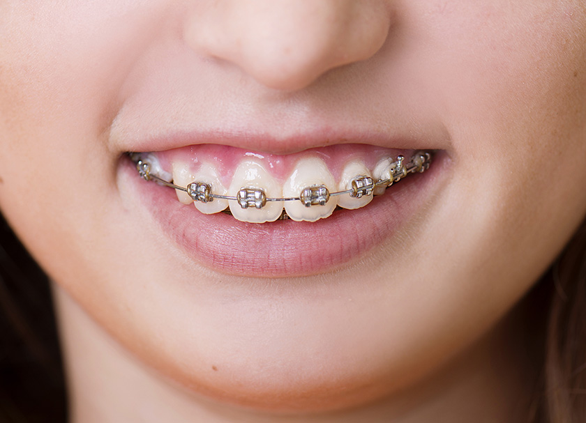 dental braces clinic in south delhi