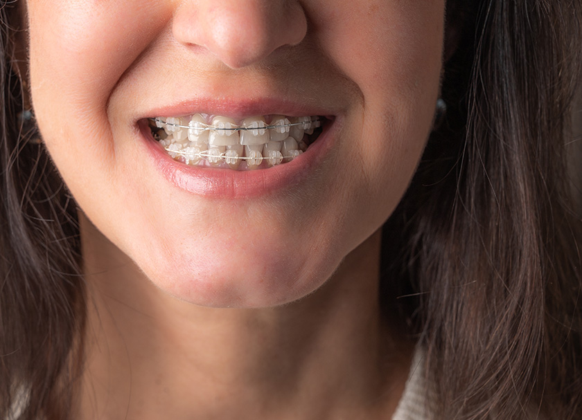 invisible dental braces clinic in delhi