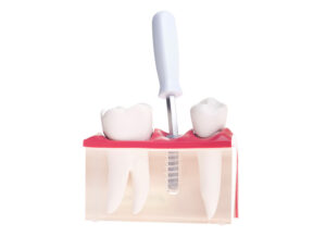 new delhi full mouth dental implants