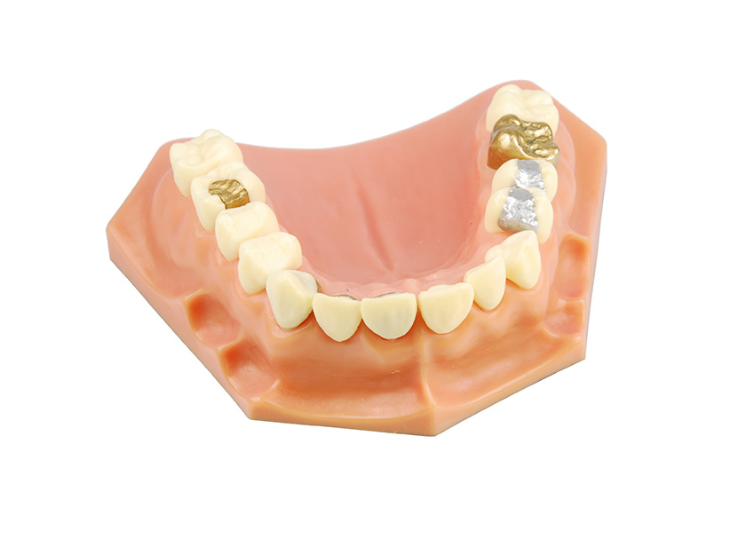 dental crown at low cost in delhi