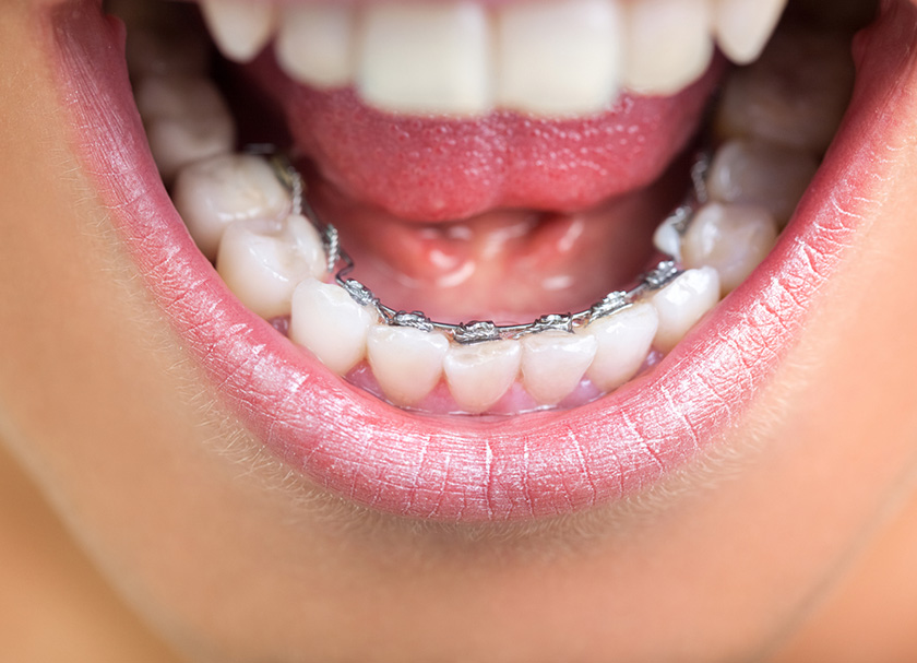 Lingual Braces