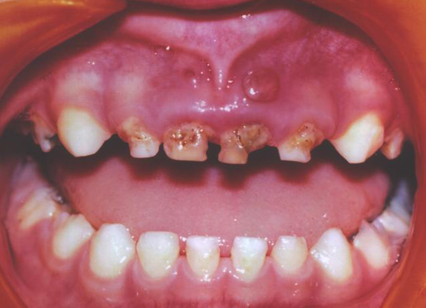 Nursing Bottle Caries