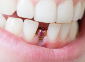 Dental Implant Clinic in Delhi and Their Services